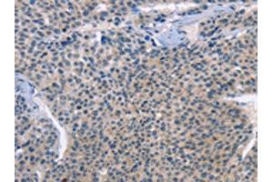 The image on the left is immunohistochemistry of paraffin-embedded Human liver cancer tissue using (LRRK2 Antibody) at dilution 1/30, on the right is treated with fusion protein. (LRRK2 Antikörper)