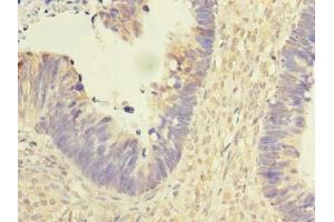 Immunohistochemistry of paraffin-embedded human ovarian cancer using ABIN7167439 at dilution of 1:100 (REEP2 Antikörper  (AA 78-252))