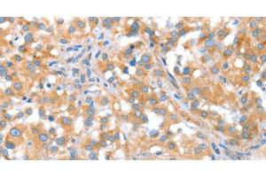 Immunohistochemistry of paraffin-embedded Human thyroid cancer tissue using ST14 Polyclonal Antibody at dilution 1:70 (ST14 Antikörper)