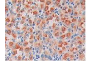 IHC-P analysis of Human Stomach Cancer Tissue, with DAB staining. (ODC1 Antikörper  (AA 15-259))