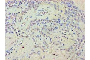 Immunohistochemistry of paraffin-embedded human breast cancer using ABIN7152359 at dilution of 1:100 (EYA2 Antikörper  (AA 1-514))