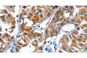 Immunohistochemistry of paraffin-embedded Human lung cancer using IGF2BP1 Polyclonal Antibody at dilution of 1:40 (IGF2BP1 Antikörper)