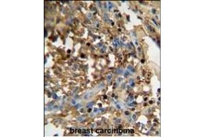 D antibody (C-term) (ABIN654936 and ABIN2844579) immunohistochemistry analysis in formalin fixed and paraffin embedded human breast carcinoma followed by peroxidase conjugation of the secondary antibody and DAB staining. (FAM20C Antikörper  (C-Term))