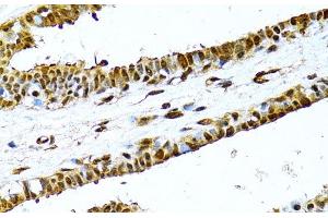 Immunohistochemistry of paraffin-embedded Human breast using NFkB p100 / p52 Polyclonal Antibody at dilution of 1:100 (40x lens). (NFKB2 Antikörper)