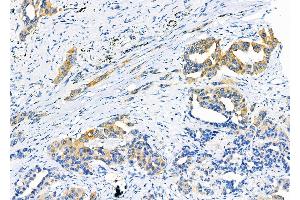 ABIN6263291 and ABIN6266590 at 1/100 staining Human lung cancer by IHC-P.