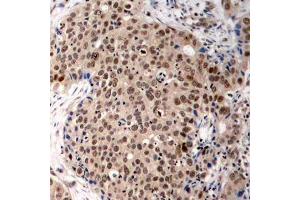 Immunohistochemistry of paraffin-embedded human breast carcinoma using Phospho-MAPKAPK2-T334 antibody (ABIN2988148). (MAPKAP Kinase 2 Antikörper  (pThr334))