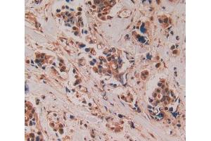 Used in DAB staining on fromalin fixed paraffin- embedded breast cancer tissue (ADAMTS5 Antikörper  (AA 485-622))