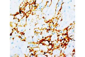 Immunohistochemical staining of human mammary cancer tissue with TNN monoclonal antibody, clone T20  at 2-4 ug/ml. (Tenascin N Antikörper)
