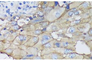 Immunohistochemistry of paraffin-embedded Human mammary cancer using CEACAM5 Monoclonal Antibody at dilution of 1:100 (40x lens). (CEACAM5 Antikörper)