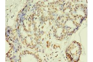 Immunohistochemistry of paraffin-embedded human breast cancer using ABIN7168449 in 30 μg/mL dilute concentrations. (RRM1 Antikörper)
