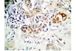 Human stomach cancer tissue was stained by rabbit anti-Spexin(H) Antiserum (Spexin Antikörper)