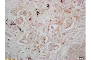 Formalin-fixed and paraffin embedded human lung carcinoma labeled with Rabbit Anti DAB2 Polyclonal Antibody, Unconjugated (ABIN760961) at 1:200 followed by conjugation to the secondary antibody and DAB staining (DAB2 Antikörper  (AA 31-130))