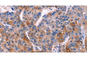 Immunohistochemistry of paraffin-embedded Human liver cancer tissue using DUSP13 Polyclonal Antibody at dilution 1:60 (DUSP13 Antikörper)