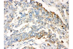 Anti- WNT2B Picoband antibody, IHC(P) IHC(P): Human Lung Cancer Tissue