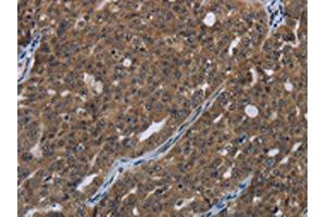 The image on the left is immunohistochemistry of paraffin-embedded Human ovarian cancer tissue using ABIN7190993(HOXC8 Antibody) at dilution 1/20, on the right is treated with synthetic peptide. (HOXC8 Antikörper)