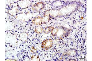 Formalin-fixed and paraffin embedded human colon carcinoma labeled with Rabbit Anti Annexin A13 Polyclonal Antibody, Unconjugated (ABIN1714416) at 1:200 followed by conjugation to the secondary antibody and DAB staining (Annexin A13 Antikörper  (AA 241-316))