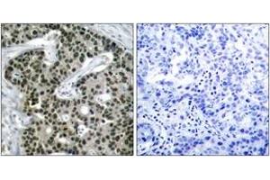 Immunohistochemistry analysis of paraffin-embedded human breast carcinoma, using HSF1 (Phospho-Ser303) Antibody. (HSF1 Antikörper  (pSer303))