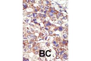 Formalin-fixed and paraffin-embedded human cancer tissue reacted with the DNMT3B polyclonal antibody  , which was peroxidase-conjugated to the secondary antibody, followed by AEC staining. (DNMT3B Antikörper  (Internal Region))