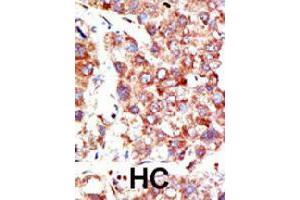 Formalin-fixed and paraffin-embedded human hepatocellular carcinoma tissue reacted with NEDD8 polyclonal antibody  , which was peroxidase-conjugated to the secondary antibody, followed by DAB staining.