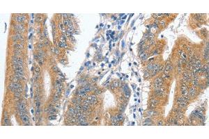 Immunohistochemistry of paraffin-embedded Human colon cancer tissue using CENPC Polyclonal Antibody at dilution 1:70 (Centromere Protein C Pseudogene 1 (CENPCP1) Antikörper)