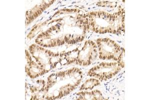 Immunohistochemistry of paraffin-embedded human colon carcinoma using TCE Rabbit mAb (ABIN7270877) at dilution of 1:25 (40x lens). (TCEA1 Antikörper)