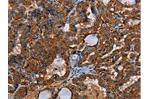 The image on the left is immunohistochemistry of paraffin-embedded Human thyroid cancer tissue using ABIN7191964(POU6F2 Antibody) at dilution 1/30, on the right is treated with synthetic peptide. (POU6F2 Antikörper)