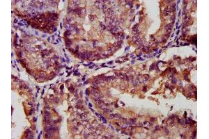 IHC image of ABIN7153467 diluted at 1:300 and staining in paraffin-embedded human endometrial cancer performed on a Leica BondTM system.