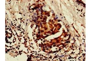 Immunohistochemistry of paraffin-embedded human breast cancer using ABIN7157103 at dilution of 1:100 (ISOC1 Antikörper  (AA 155-298))