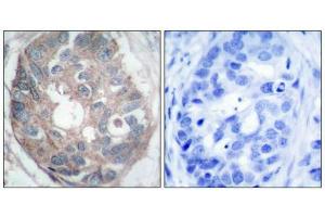Immunohistochemical analysis of paraffin-embedded human breast carcinoma tissue using Dab1(Ab-232) Antibody(left) or the same antibody preincubated with blocking peptide(right). (DAB1 Antikörper)