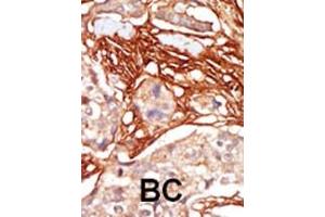 Formalin-fixed and paraffin-embedded human cancer tissue reacted with the primary antibody, which was peroxidase-conjugated to the secondary antibody, followed by AEC staining. (ARAF Antikörper  (AA 256-286))