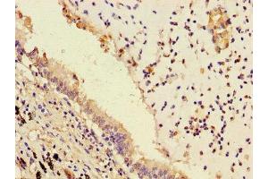 Immunohistochemistry of paraffin-embedded human lung cancer using ABIN7163357 at dilution of 1:100 (PPAP2B Antikörper  (AA 144-193))