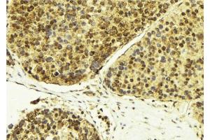 ABIN6274283 at 1/100 staining Human breast cancer tissue by IHC-P. (RBM5 Antikörper  (N-Term))
