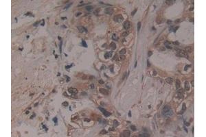Detection of ADAMTS5 in Human Pancreatic cancer Tissue using Polyclonal Antibody to A Disintegrin And Metalloproteinase With Thrombospondin 5 (ADAMTS5) (ADAMTS5 Antikörper  (AA 485-622))
