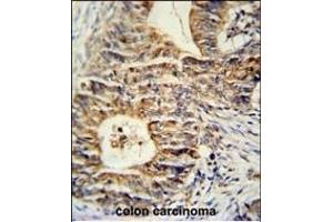 KLHL24 Antibody (Center) (ABIN651431 and ABIN2840236) immunohistochemistry analysis in formalin fixed and paraffin embedded human colon carcinoma followed by peroxidase conjugation of the secondary antibody and DAB staining. (Kelch-Like 24 Antikörper  (AA 182-211))