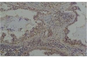 Immunohistochemistry of paraffin-embedded Human lung carcinoma tissue with Phosphoserine Monoclonal Antibody at dilution of 1:200 (Phosphoserine Antikörper)