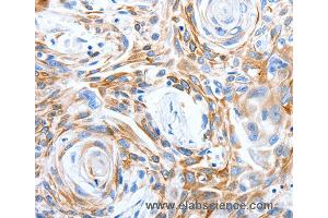 Immunohistochemistry of Human esophagus cancer using LRIG3 Polyclonal Antibody at dilution of 1:50 (LRIG3 Antikörper)
