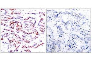 Immunohistochemical analysis of paraffin-embedded human breast carcinoma tissue using ATF2(Phospho-Thr71 or 53) Antibody(left) or the same antibody preincubated with blocking peptide(right). (ATF2 Antikörper  (pThr71))