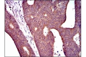 Immunohistochemical analysis of paraffin-embedded rectum cancer tissues using PDE1B mouse mAb with DAB staining.