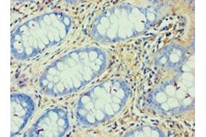 Immunohistochemistry of paraffin-embedded human colon cancer using ABIN7144823 at dilution of 1:100 (ATP5F1 Antikörper  (AA 1-245))