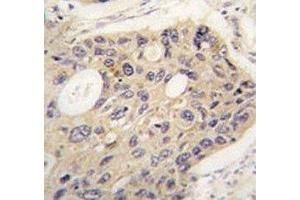 IHC analysis of FFPE human lung carcinoma tissue stained with ATG12 antibody (ATG12 Antikörper)
