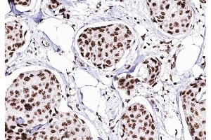 ABIN6276373 at 1/200 staining human Breast cancer tissue sections by IHC-P. (CDK4 Antikörper  (Internal Region))