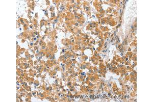 Immunohistochemistry of Human liver cancer using CHMP4B Polyclonal Antibody at dilution of 1:40 (CHMP4B Antikörper)