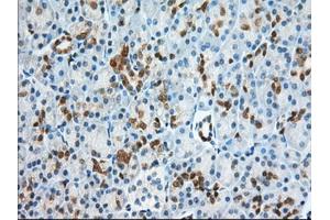 Immunohistochemical staining of paraffin-embedded Adenocarcinoma of Human ovary tissue using anti-BDH2 mouse monoclonal antibody. (BDH2 Antikörper)