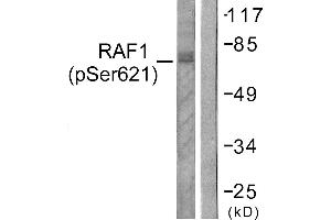 Immunohistochemistry analysis of paraffin-embedded human lung carcinoma tissue using Raf1 (Phospho-Ser621) antibody. (RAF1 Antikörper  (pSer621))