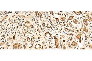 Immunohistochemistry of paraffin-embedded Human prost ate cancer tissue using SOX3 Polyclonal Antibody at dilution of 1:50(x200) (SOX3 Antikörper)