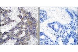 Immunohistochemistry analysis of paraffin-embedded human breast carcinoma tissue, using JAK2 (Ab-1007) Antibody. (JAK2 Antikörper  (AA 981-1030))