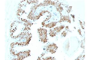 Formalin-fixed, paraffin-embedded human Prostate Carcinoma stained with p57 Mouse Monoclonal Antibody (SPM308). (CDKN1C Antikörper)