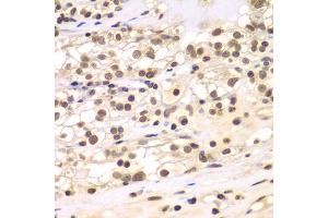 Immunohistochemistry of paraffin-embedded human kidney cancer using ULK4 antibody. (ULK4 Antikörper)
