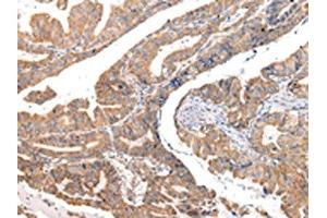 The image on the left is immunohistochemistry of paraffin-embedded Human esophagus cancer tissue using ABIN7190330(COL8A2 Antibody) at dilution 1/20, on the right is treated with synthetic peptide. (COL8a2 Antikörper)