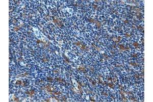 Immunohistochemical staining of paraffin-embedded Human lymphoma tissue using anti-MICAL1 mouse monoclonal antibody. (MICAL1 Antikörper)
